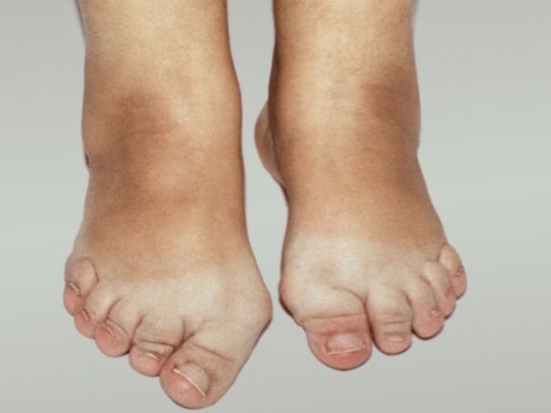 Osteoartriti i këmbës me deformim të rëndë të gishtërinjve