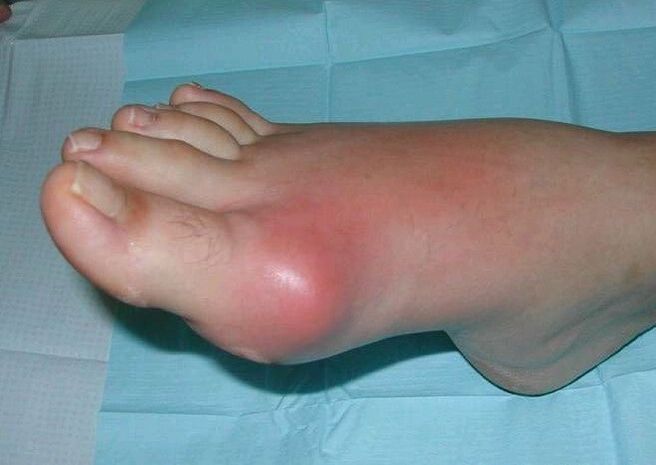 Pamja klinike e artritit të këmbës - ënjtje dhe inflamacion