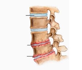 Osteokondrozë