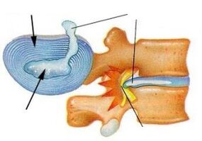 shkatërrimi i unazës fibroze në osteokondrozën e qafës së mitrës