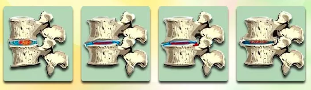 Fazat e zhvillimit të osteochondrosis