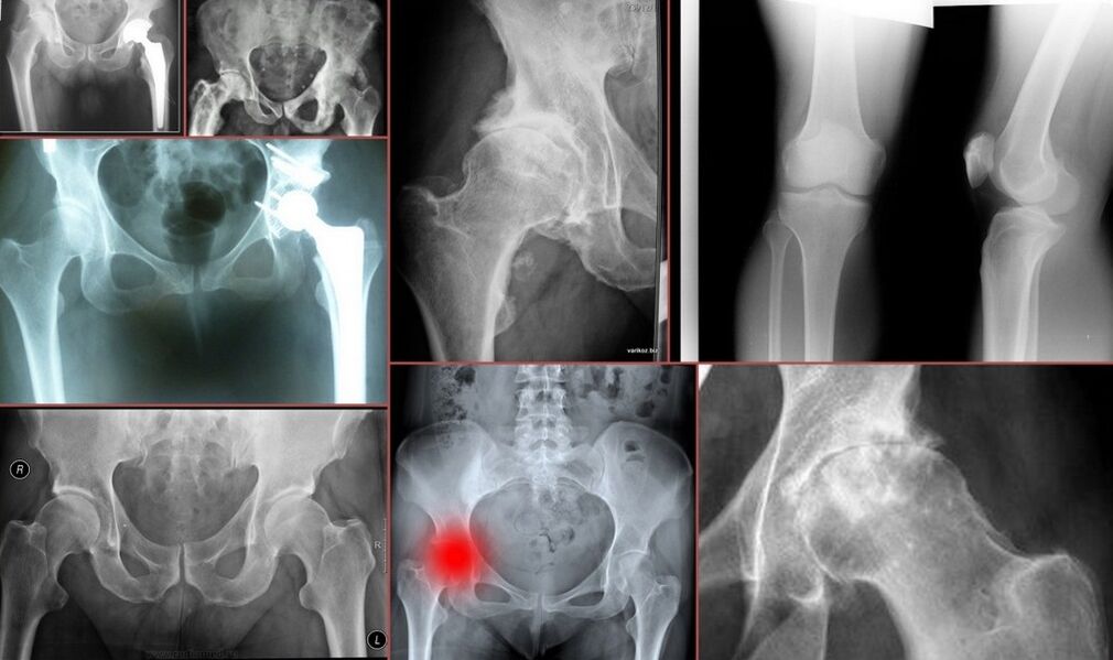 X-ray për dhimbjen e ijeve