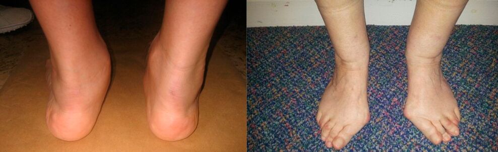 Artroza e gishtit të madh të këmbës dhe artroza deformuese e kyçit të këmbës