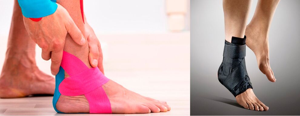 Ortoza dhe ngjitja e kyçit të kyçit të këmbës në rast të artrozës