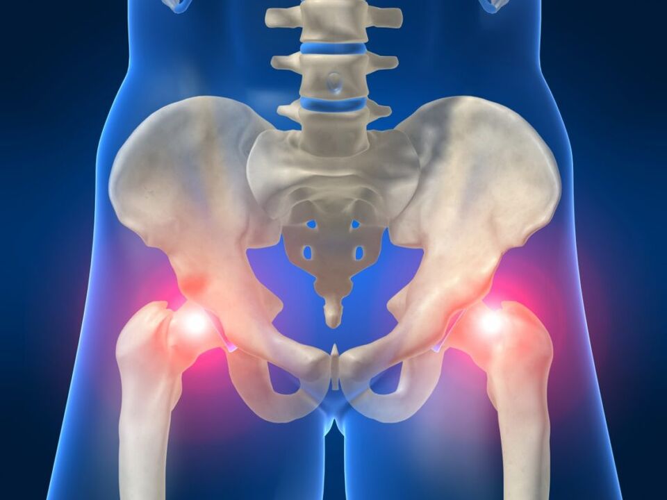 Në spondilitin ankilozant, dhimbja dypalëshe në nyjen e hipit është shqetësuese