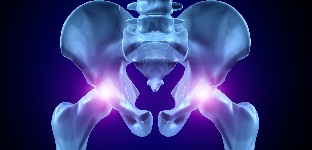 osteoarthritis e hip përbashkët